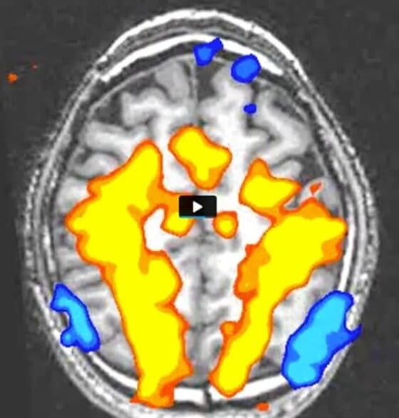 fMRI Brain Scan